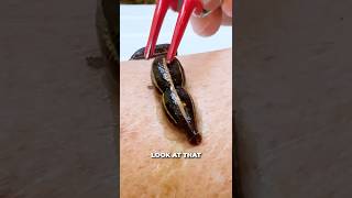 Blood Sucking Parasite Latches on my Arm!