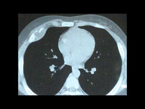 TUBERCULAR ABSCESS( COLD Abscess ) Anterior Chest Wall.HOW TO MANAGE?