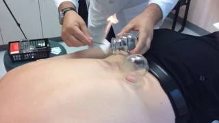 What is cupping, and who could benefit from it?