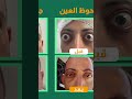 لا تفقد الأمل اذا عندك جحوظ بالعين 