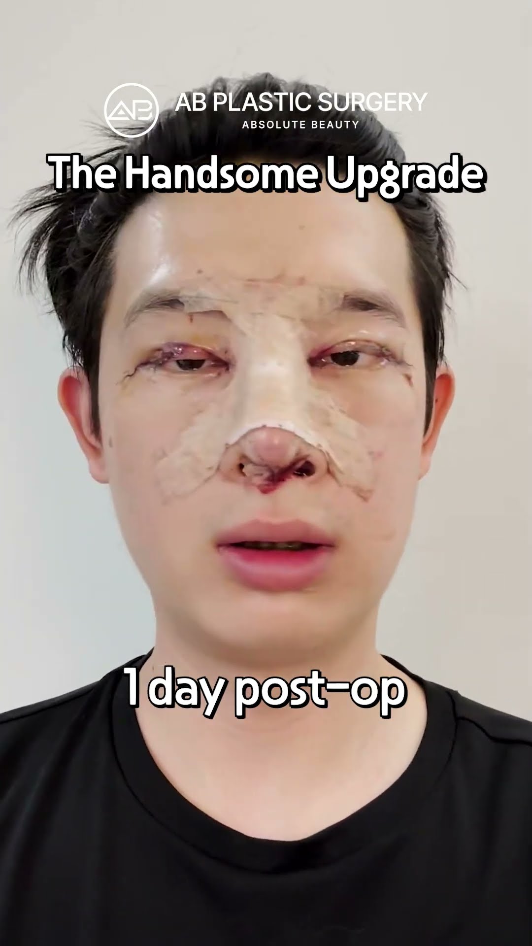 His Nose & Eye Surgery Journey in Korea #shorts