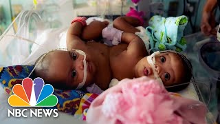 Conjoined twins separated in miracle procedure