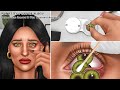 Asmr                 contact lens removal  stye treatment