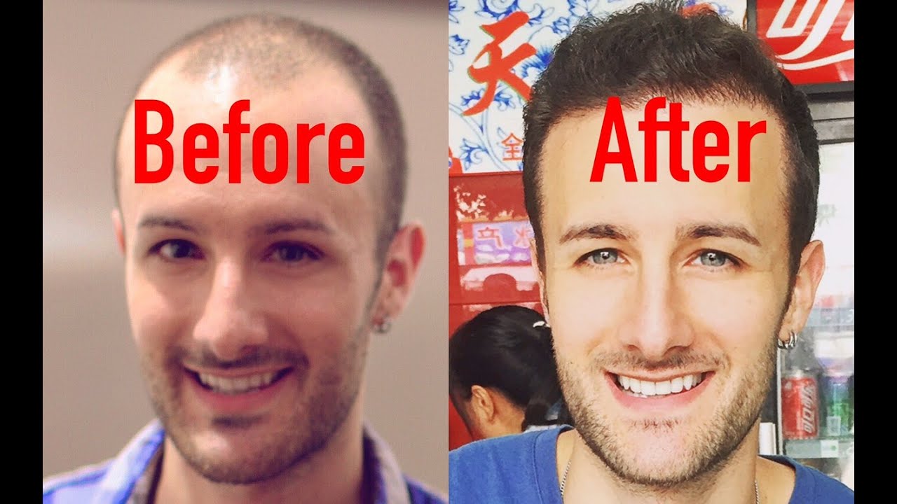 ENTIRE Hair Transplant Surgery Video Beginning To End YouTube