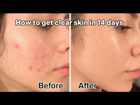 HOW TO GET CLEAR SKIN AT HOME | BEAUTY TIPS TO GET CLEAR SKIN - YouTube