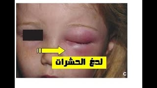 حساسية العين وعلاجها