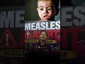 खतरे की घंटी! Measles Outbreak तेजी से फैल रहा है ⚠️ #short