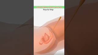 Female Urinary Catheter Insertion