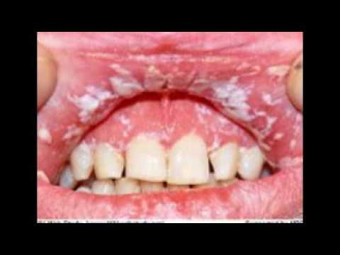 sintomas da AIDS fique atento - YouTube