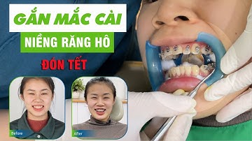 Gắn mắc cài niềng răng hô - Tết này có thêm trang sức mới trên răng