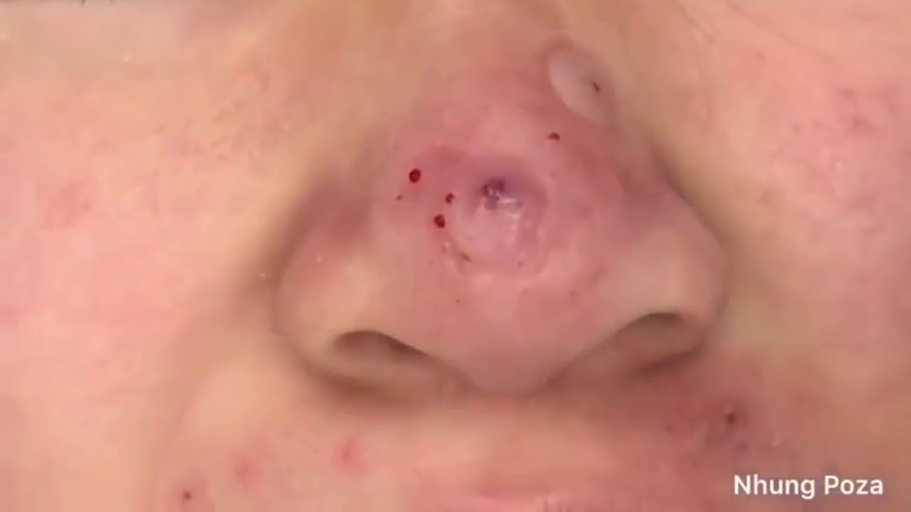 blackheads removal youtube 2019 YouTube