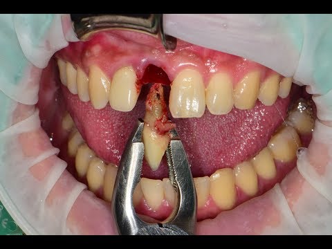 Immediate implant placement & Immediate restoration