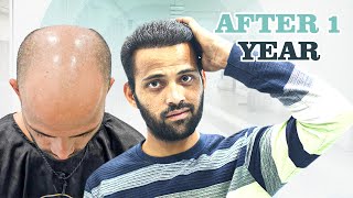 From Zero to Hero: See the Astonishing 1 Year Result 😍 | Hair Transplant Nagpur | New Roots
