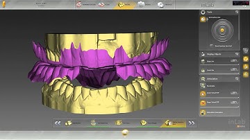 inLab SW 15 integration with SICAT Function