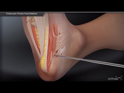 Endoscopic Plantar Fascia Release