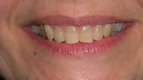 Invisalign Treatment -- Closing Spaces