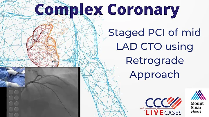 Staged PCI of mid LAD CTO using Retrograde Approach - September 17, 2013 Webcast Video