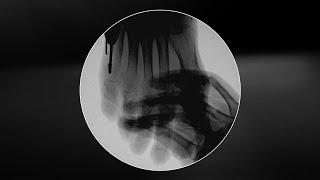 Minimally Invasive Exostectomy of a Type 1 Tailor’s Bunion