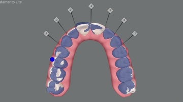 Complex invisalign case: ClinCheck Simulation for Severe Crowding and Deep Bite Correction