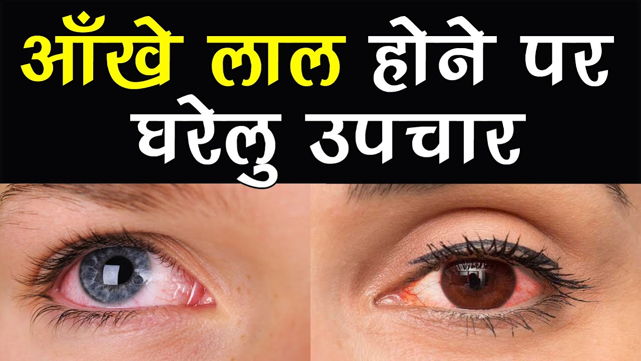 how to cure eye redness in hindi आँखों की लालिमा (लाल आँखे) का घरेलू