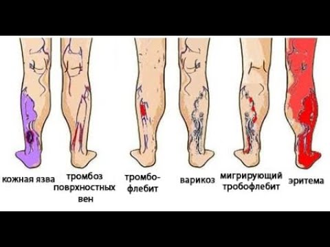 Лечится ли Тромбофлебит гирудотерапией?