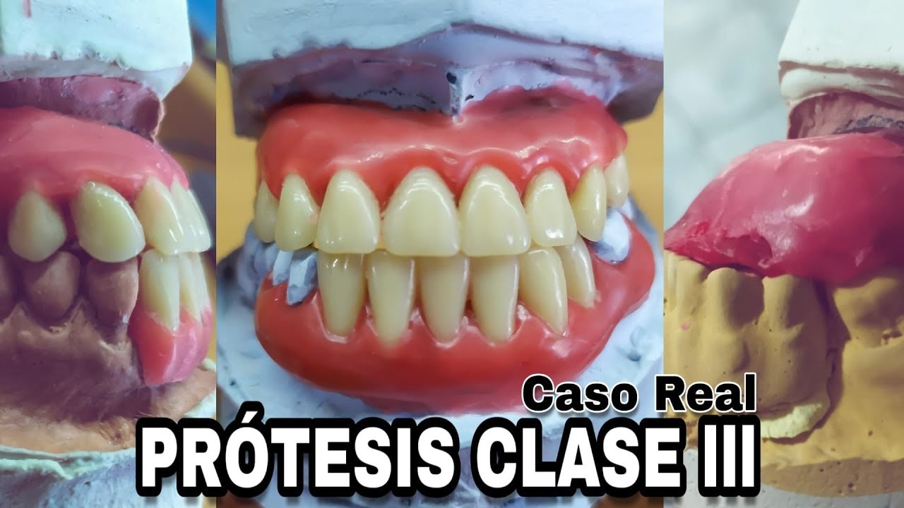 PRÓTESIS DENTAL CLASE 3 : Caso Real