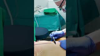 360 tummy tuck and liposuction with plastic surgeon M. Kievisas #plasticsurgery #tummytuck #shorts