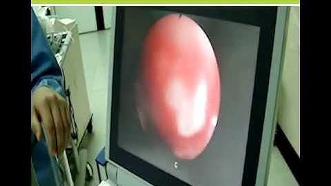 A wake Intubation Made Easy