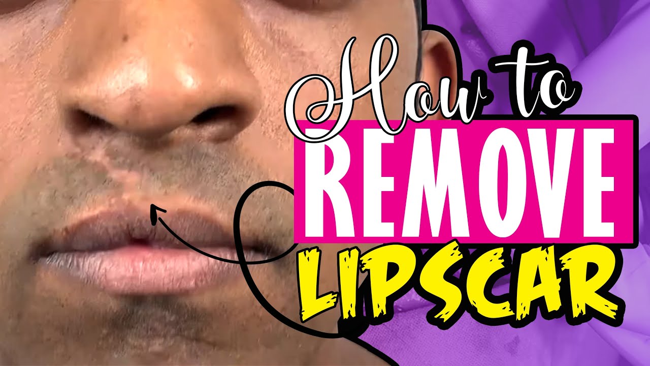 how to remove lip scar, best scar removal surgery, cost cleft lip, cost cle...