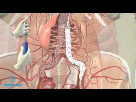 Video: Abdominaal Aorta-aneurysma - Symptomen, Behandeling, Operatie, Breuk