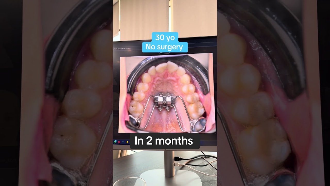 #безоперационноенет