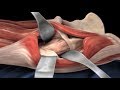 Learn About Anterior Approach Total Hip Replacement