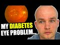 This Happens to Your Eyes if Your Blood Sugar is High | My Diabetes Retinopathy Story