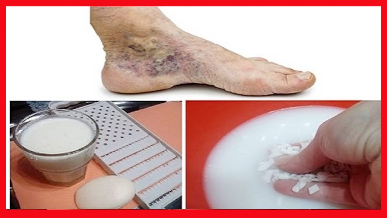 Tratamento De Varizes Aplique Isto Nas Varizes Por 30 Dias E Veja O Que 