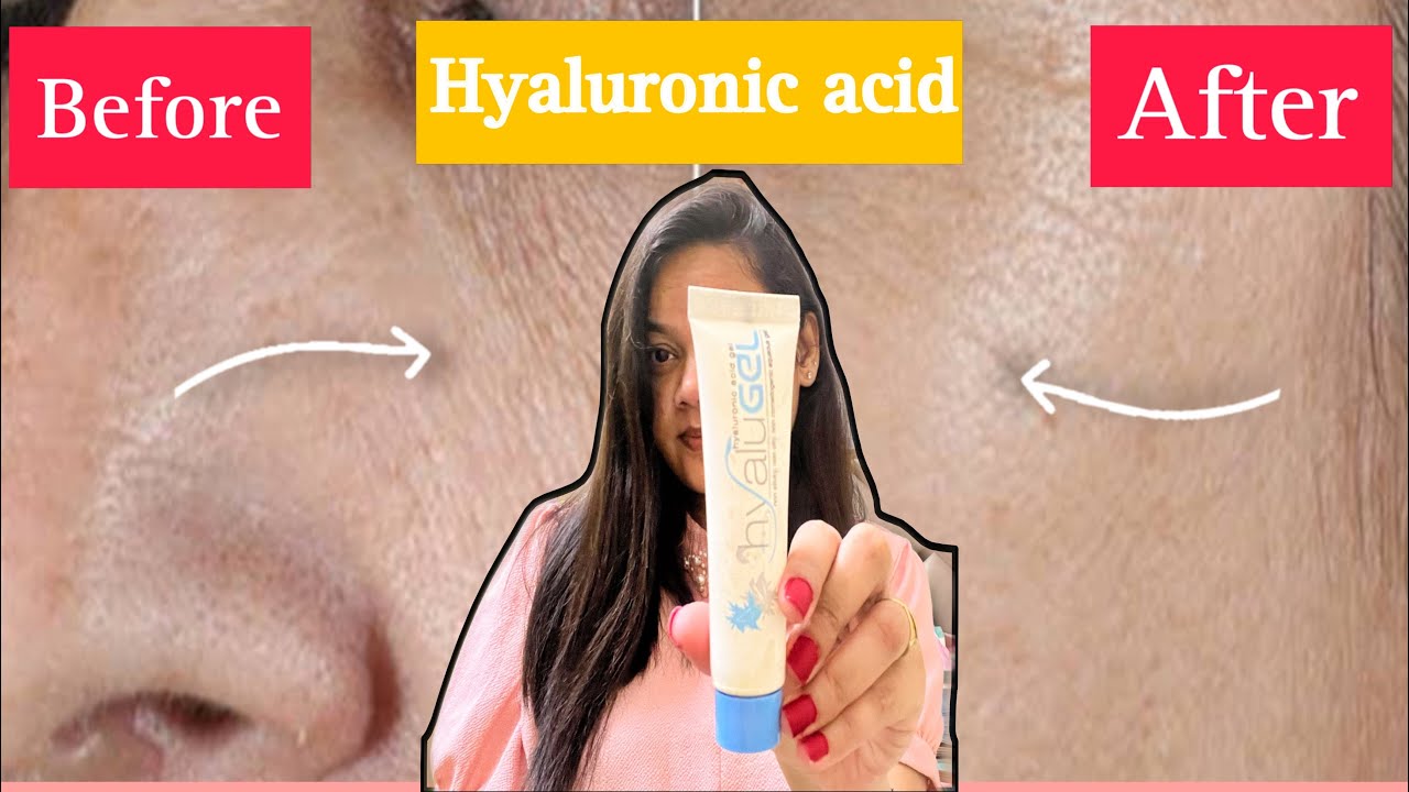 HYALU GEL HYALURONIC ACID gel Honest Review after Using 1 Month Uses