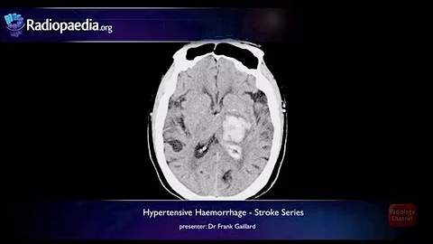 Stroke: Hypertensive haemorrhage - radiology video tutorial (MRI, CT) - DayDayNews