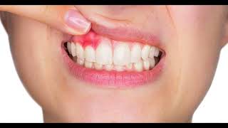 Gum Disease Stage 2: Early Periodontitis