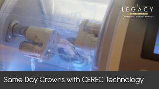 Crowns, Implants, and Veneers All In ONE Visit! How Can It Be Done?