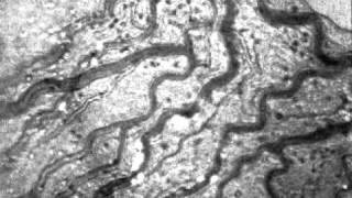Microscopic Iris Video Stabilization Using Rasl After Stabilization