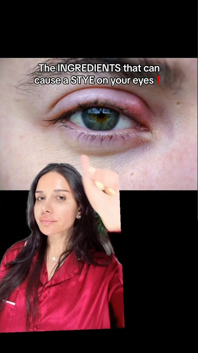 These can cause a Stye on your eyes! #skincareproblems #acneskincare #stye #eyes #skincareroutine