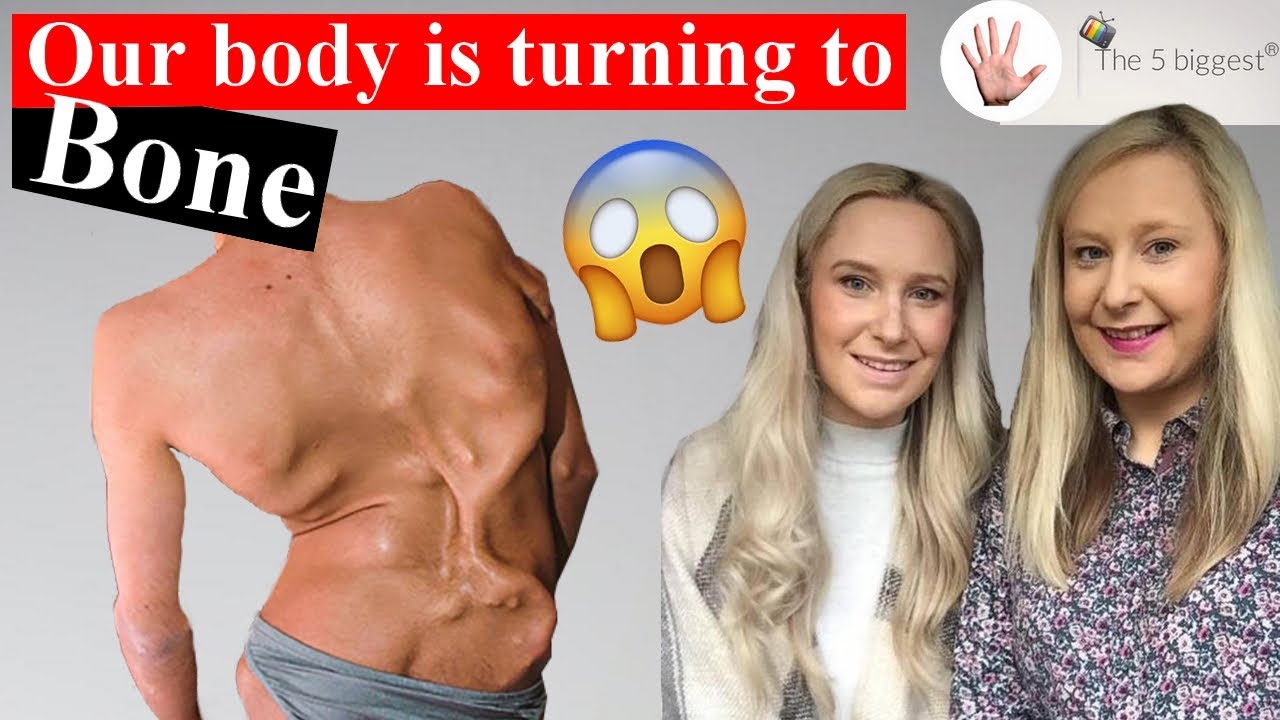 Ultra Rare Disease is Tuning Us to a Human Statue of Bone 🗽! Body