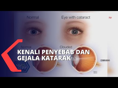 Tak Hanya Diderita Orang Dewasa, Kenali Gejala Awal Katarak