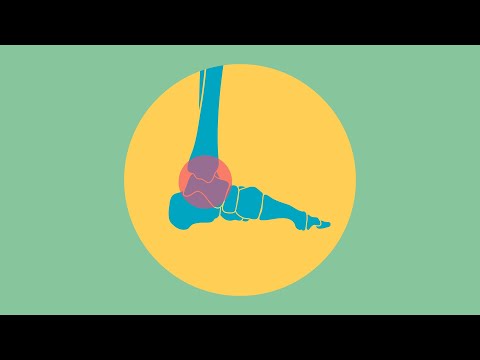Vídeo: 4 maneres de tractar un esquinç de turmell