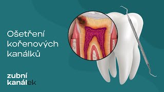 Endodoncie - ošetření kořenových kanálků