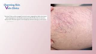 Charming Skin Vein Clinics Oakbrook - What Are the Best Treatment Options for Varicose Veins? screenshot 3