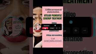 VITILIGO PIGMENTOZ COVERUP TREATMENT | VITILIGO MICROPIGMENTATION | vitiligo permanent pigmentation