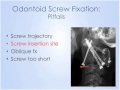 Spine: Odontoid Fractures Anterior Treatment