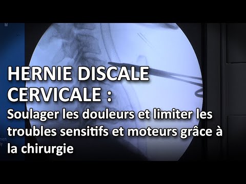 Vidéo: Une hernie discale peut-elle provoquer des maux de tête ?