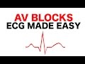 AV Blocks (1st, 2nd, and 3rd Degree)