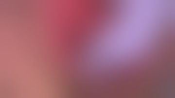 Physics Forceps Extraction of Lower Right w/ Decay from GoldenDent, Atraumatic Extraction